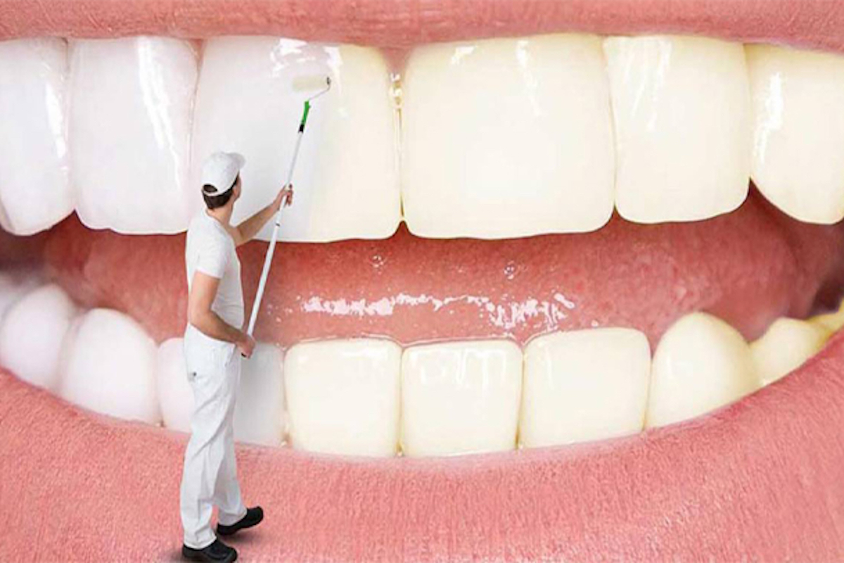 سفید شدن دندان-1
