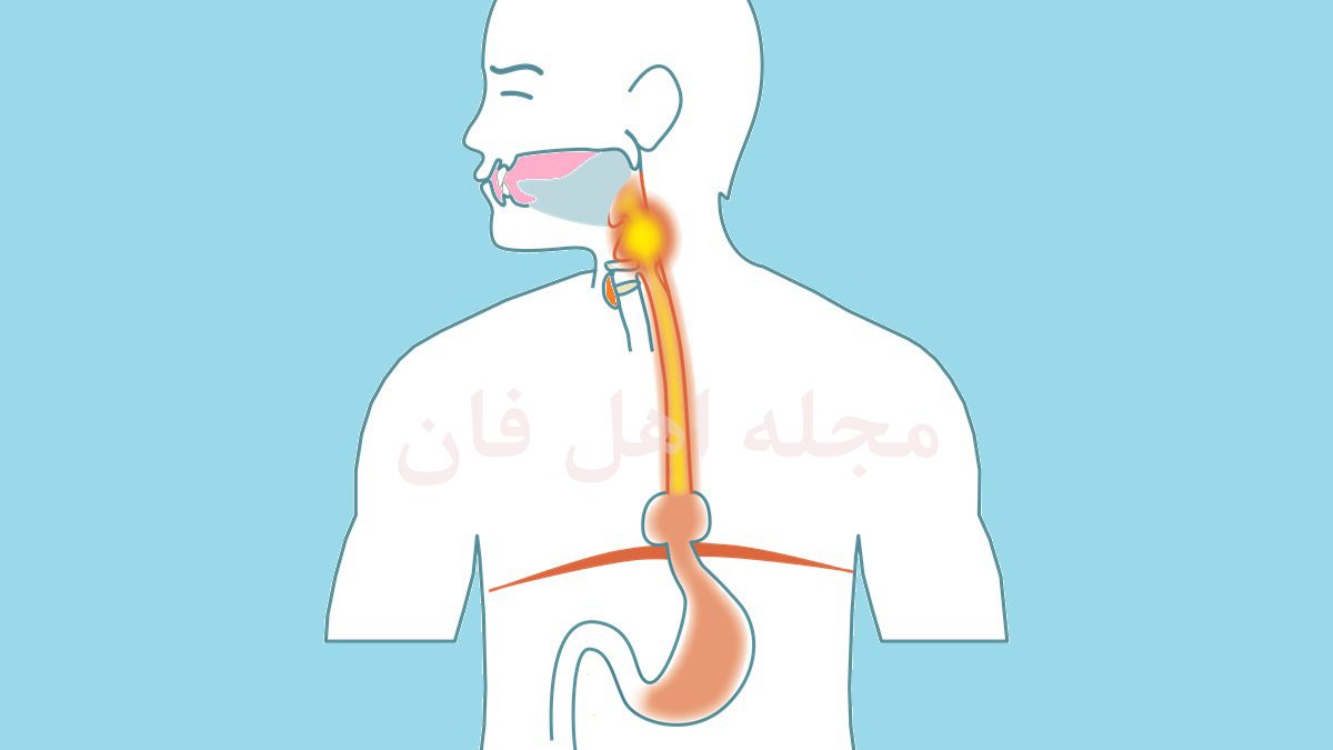 درمان رفلاکس معده در طب سنتی