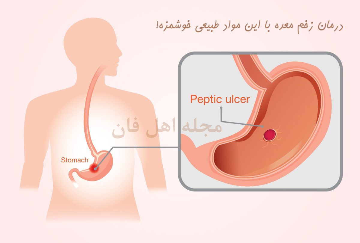 درمان زخم معده